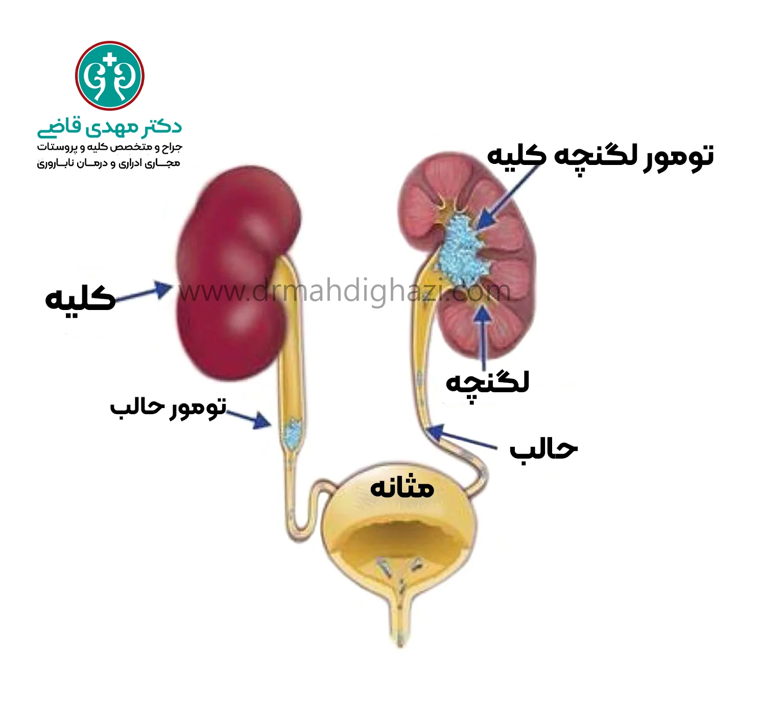 دکتر قاضی علائم سرطان کلیه و حالب