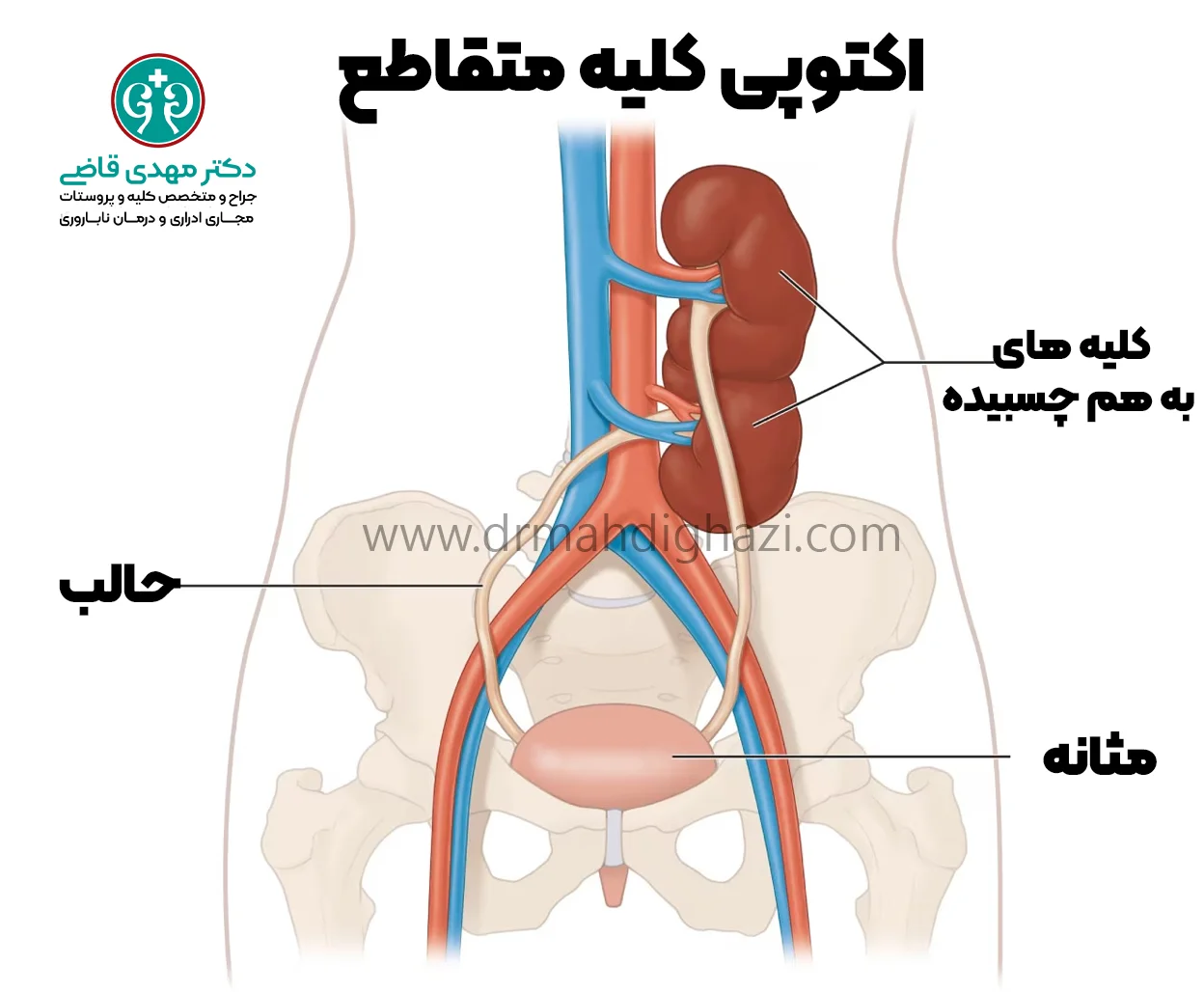 دکتر قاضی -اکتوپی کلیه متقاطع