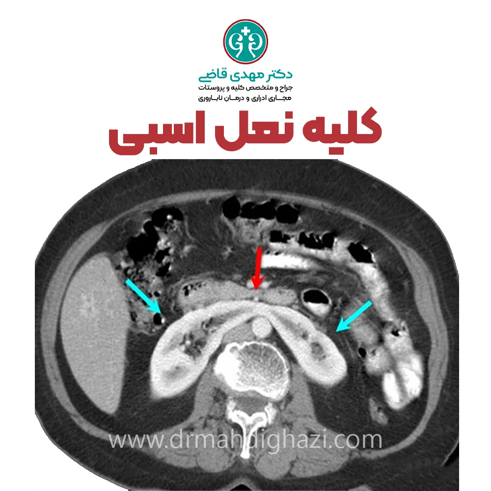 الدكتور مهدي قاضي-کلیه نعل اسبی