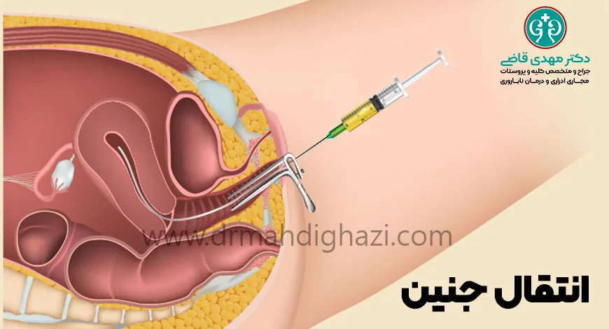 دکتر قاضی- تکنیکهای IVF