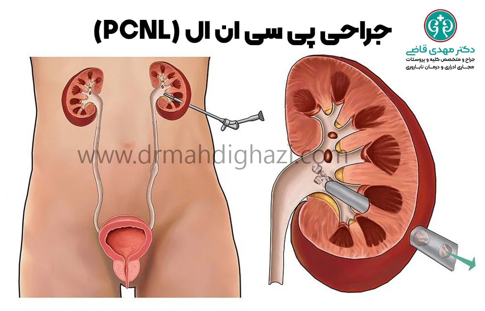 دکتر قاضی-کیست کلیه: علل، علائم، تشخیص و روش‌های درمان