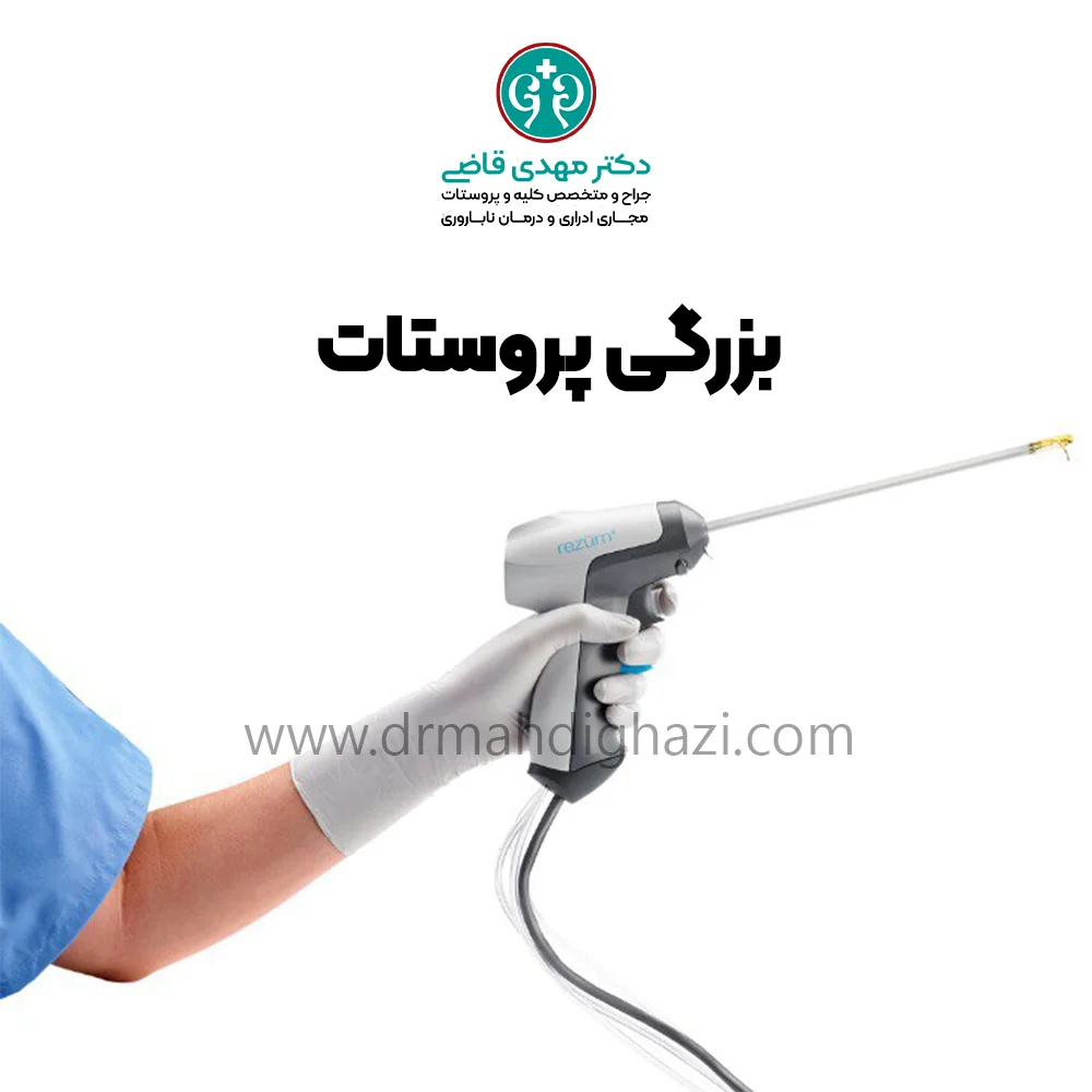 دکتر قاضی-هایپرپلازی خوش خیم پروستات BPH