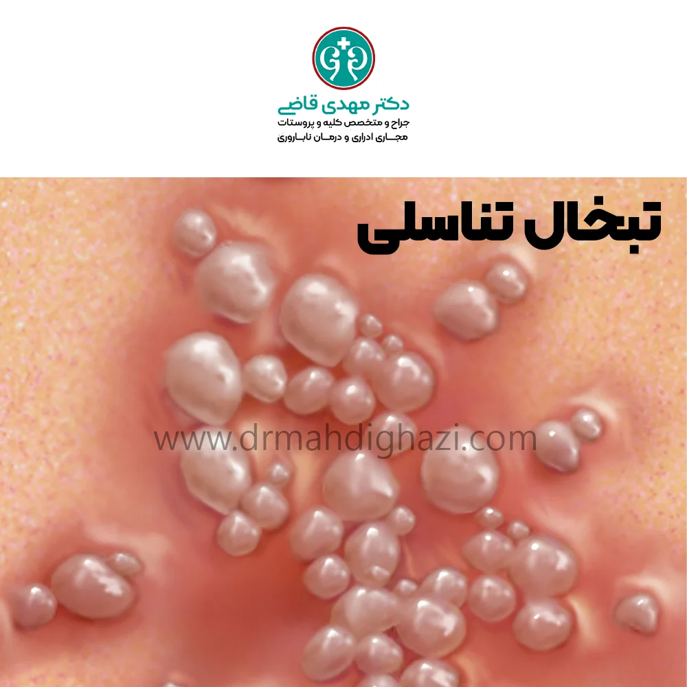 دکتر قاضی- تبخال تناسلی