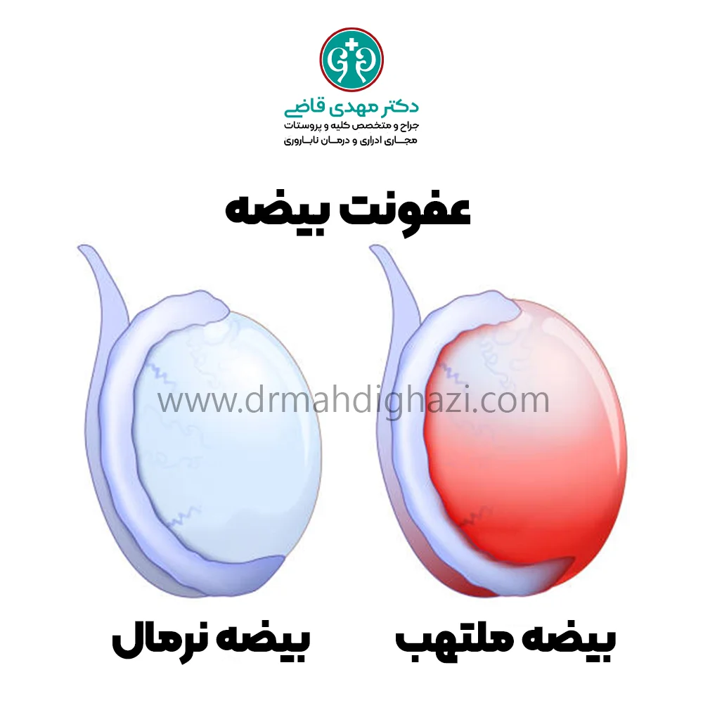 دکتر قاضی- عفونت بیضه