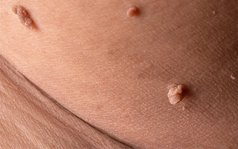 آگاهی از روش‌های انتقال زگیل تناسلی و ویروس HPV؛ لازمه پیشگیری